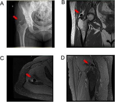 Endoscopic treatment for calcific tendinitis of the gluteus medius: A case report and review